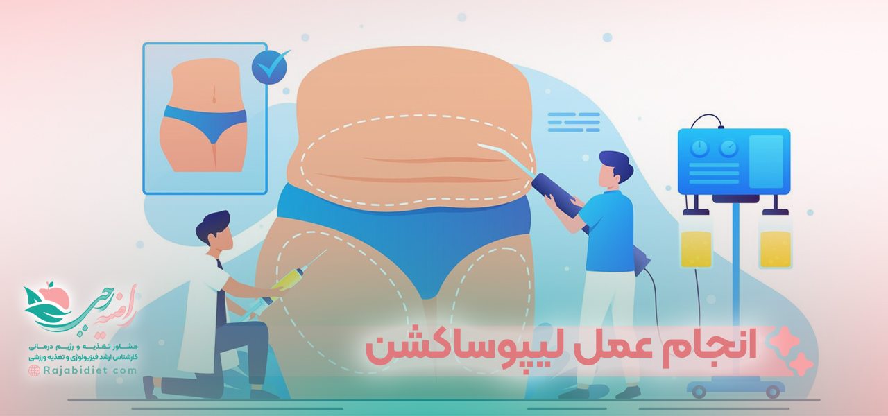 انجام عمل لیپوساکشن