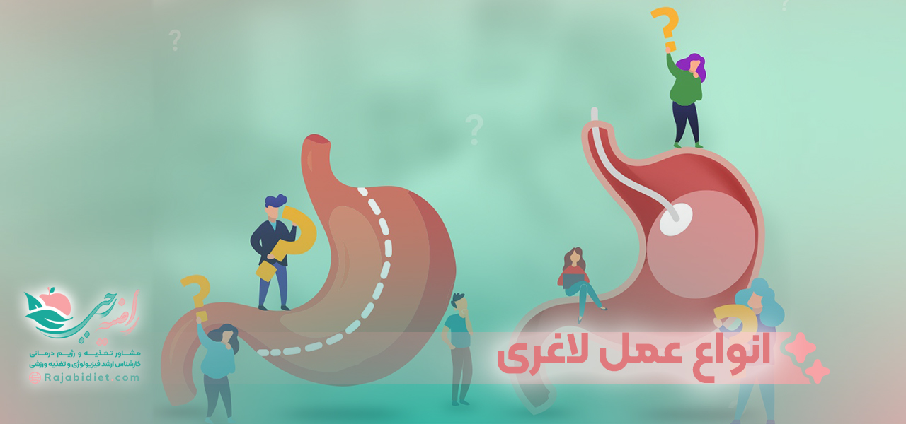 انجام بالون معده