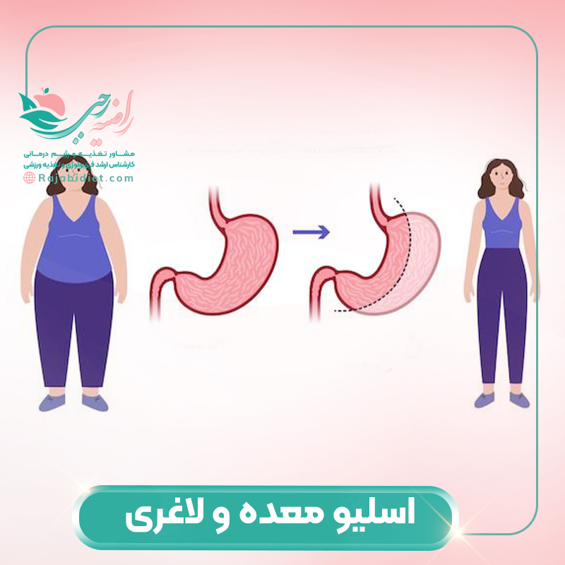 اسلیو معده روشی برای لاغری