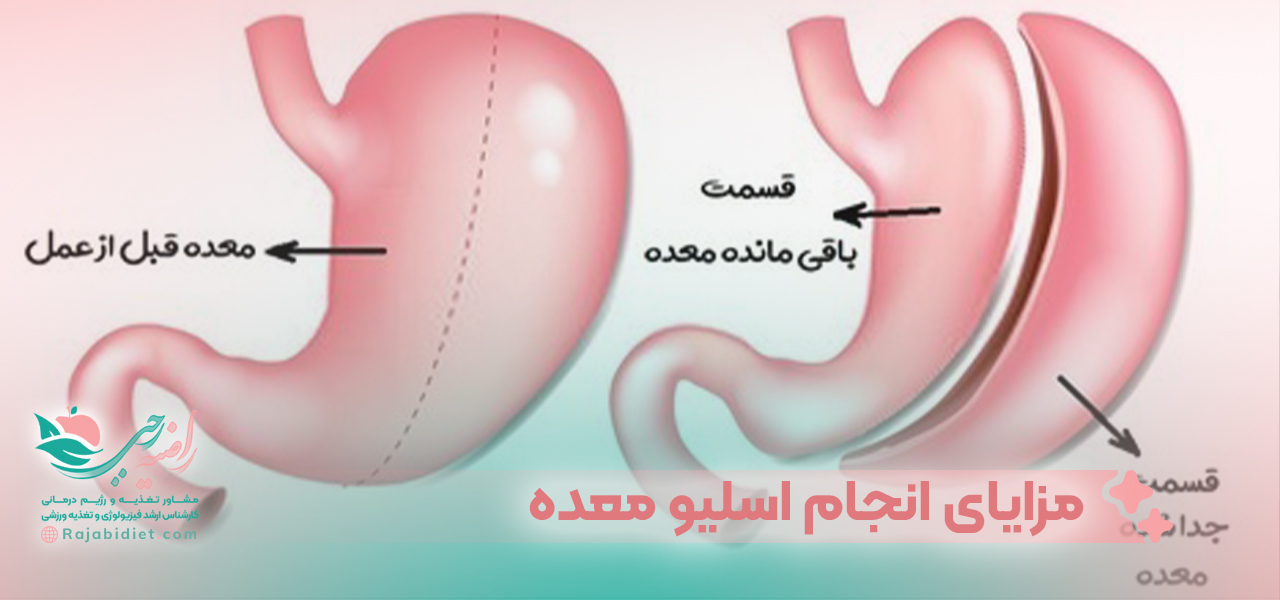 مزایای انجام اسلیو معده