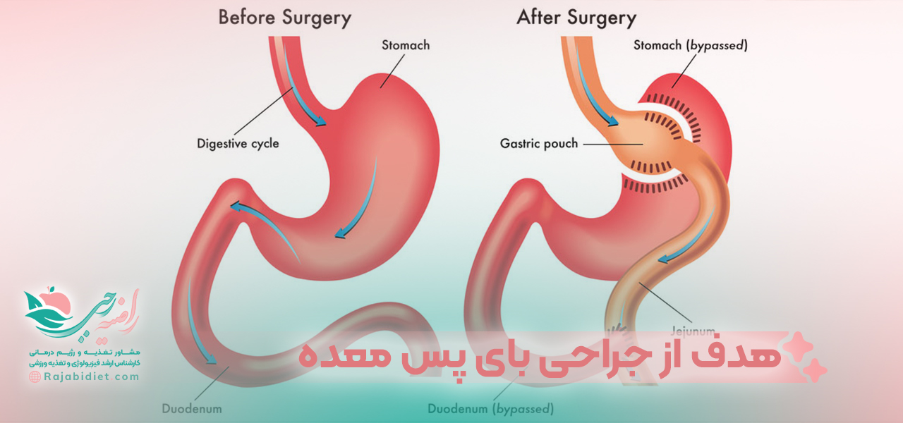 هدف از انجام جراحی بای پس معده