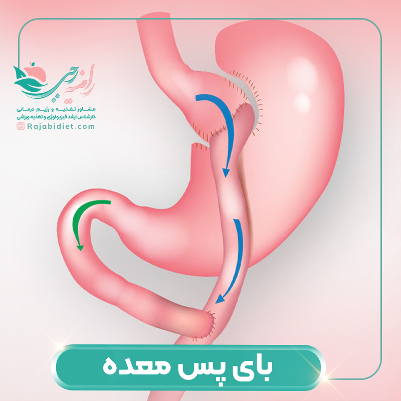 بای پس معده روشی نوین برای لاغری