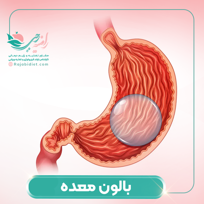 بالون معده روشی منسوخ شده برای درمان چاقی