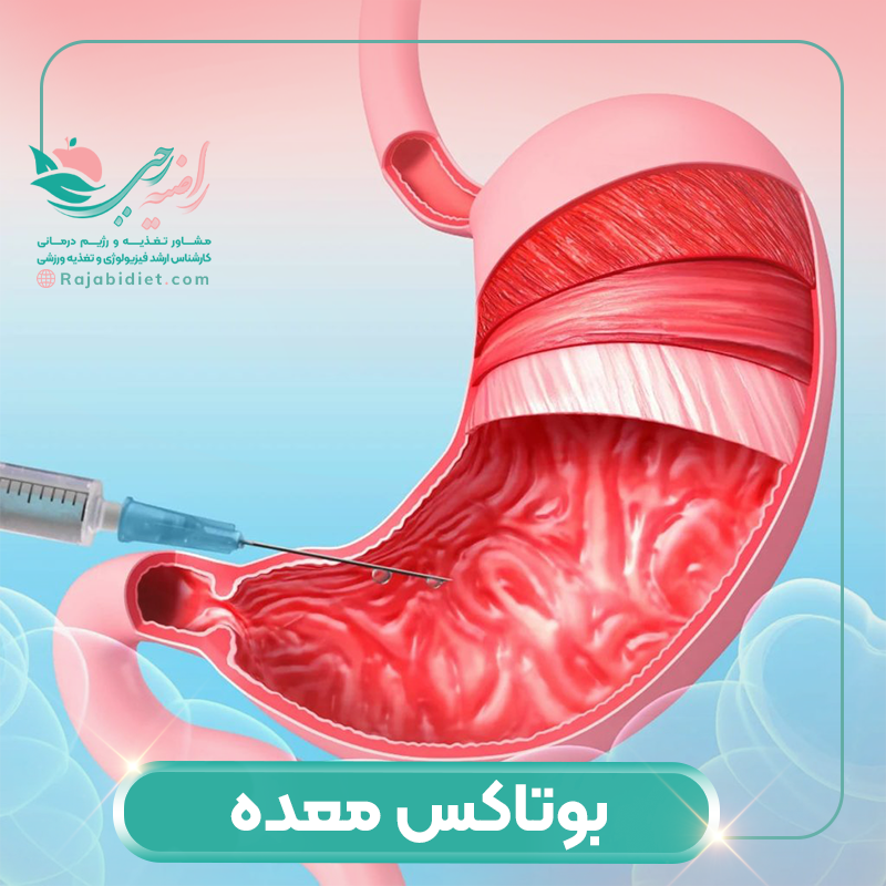 بوتاکس معده چیست؟ آیا روشی برای لاغری است؟