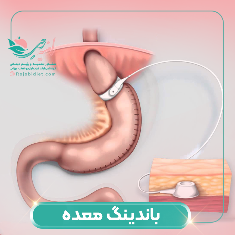 باندینگ معده چیست و چه عوارضی دارد؟